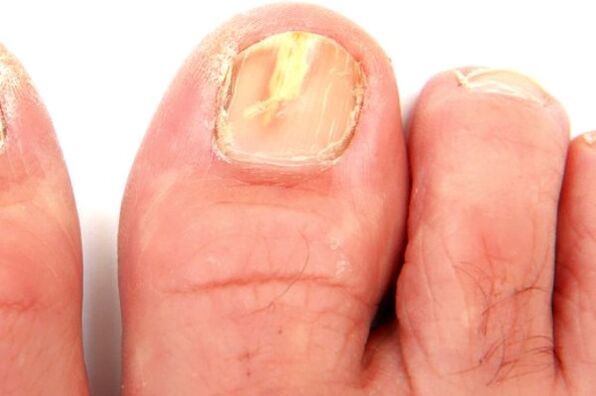 оштетување на плочата на ноктите поради габична инфекција